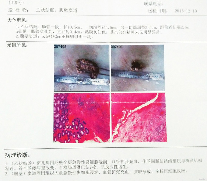 腹壁窦道1例