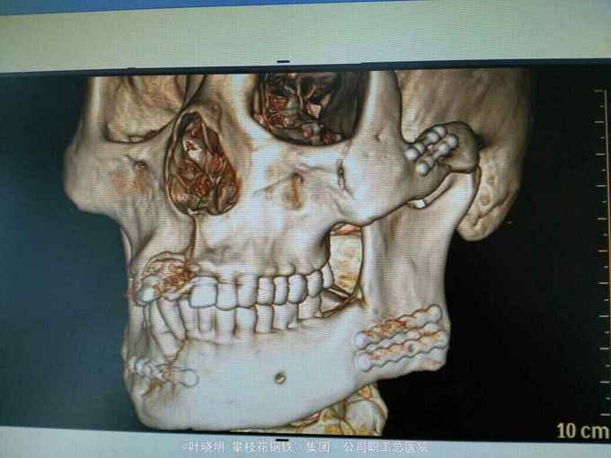 右下颌颏部,左下颌角部,左颧骨骨折切开复位内固定
