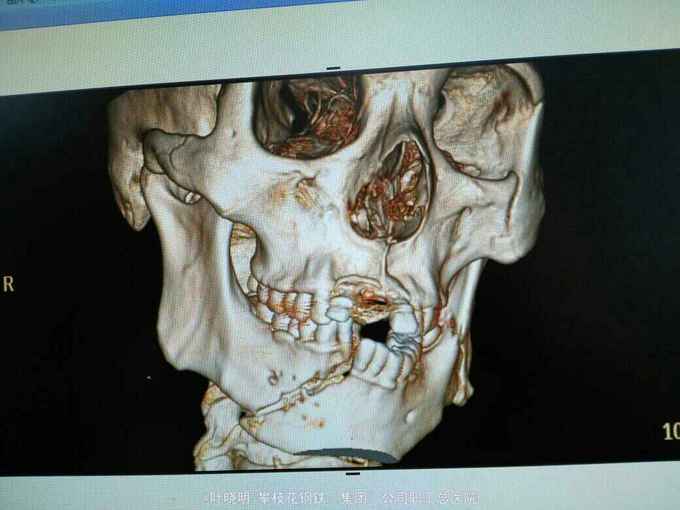 右下颌颏部,左下颌角部,左颧骨骨折切开复位内固定