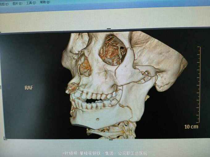 右下颌颏部左下颌角部左颧骨骨折切开复位内固定