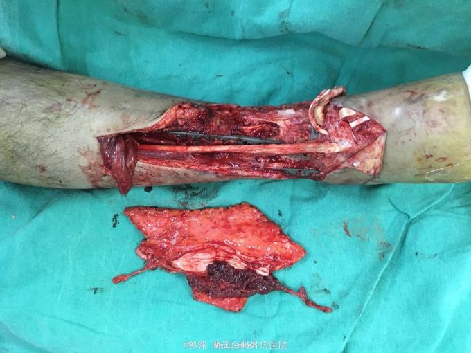 小腿开放骨折皮肤软组织坏死游离皮瓣移植修复