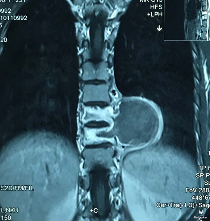胸椎椎体血管瘤病例