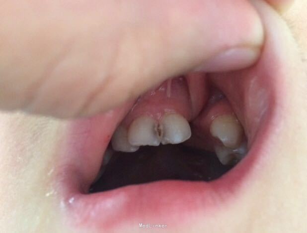 21与23间牙槽裂开,黏膜无红肿.cbct示21与23间牙槽骨裂开.