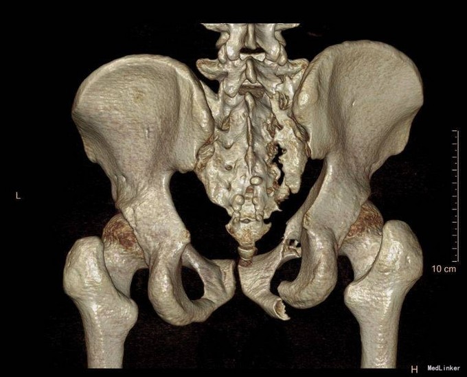 骨盆骨折(tile c1 型),骶骨骨折(denis 2型), 腰骶神经损伤