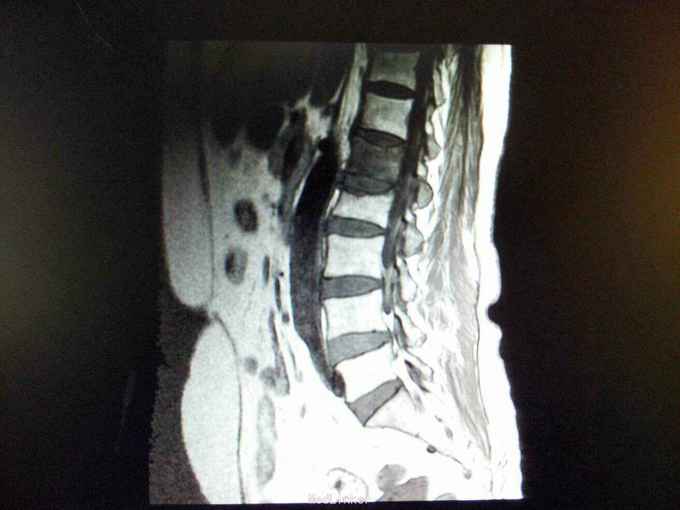 脊柱压缩性骨折一例