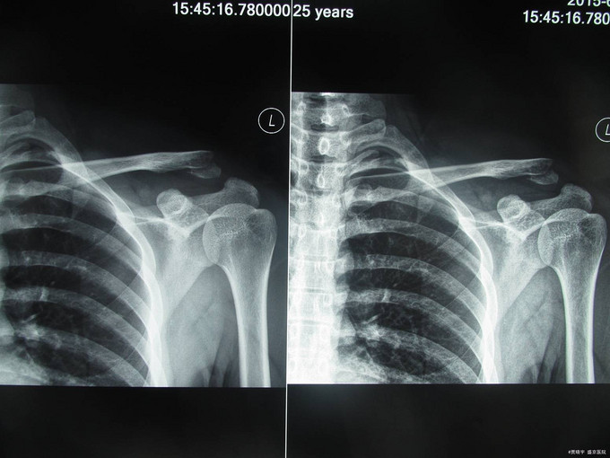左锁骨肩峰端骨折