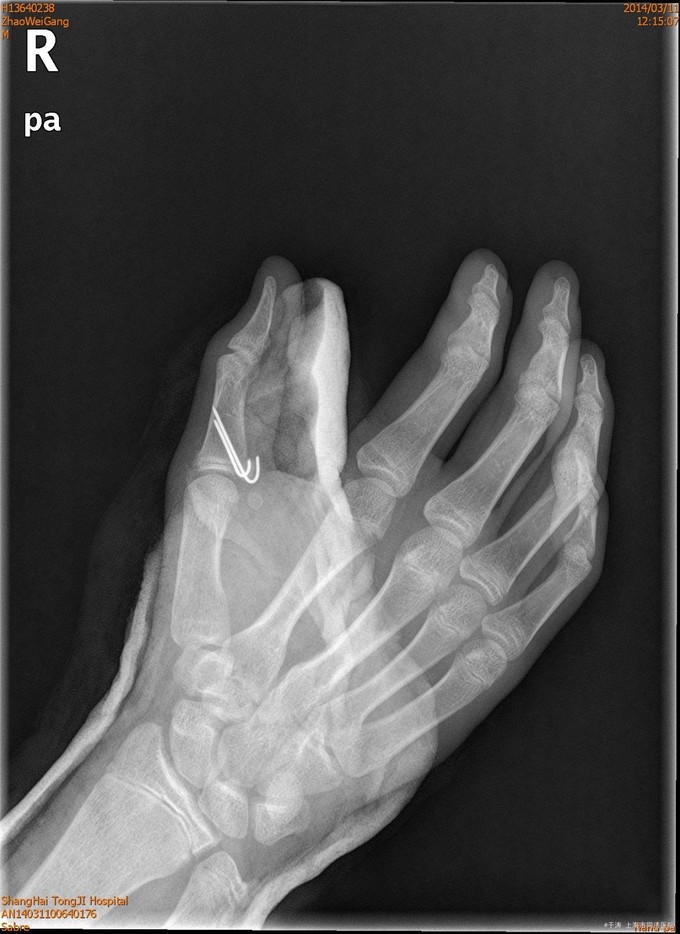 拇指近节指骨骨折
