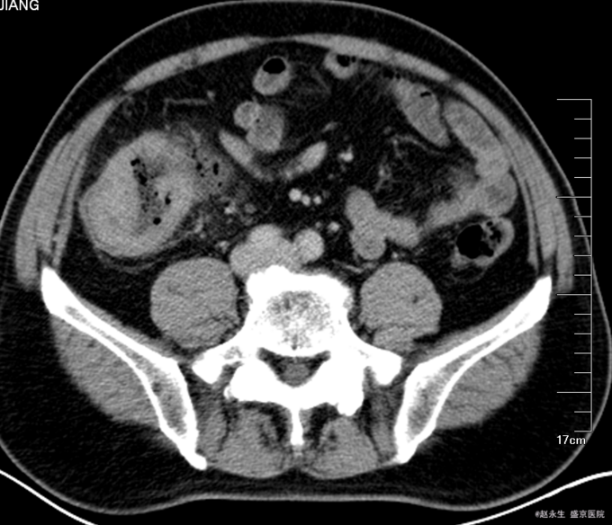 盲肠癌1例