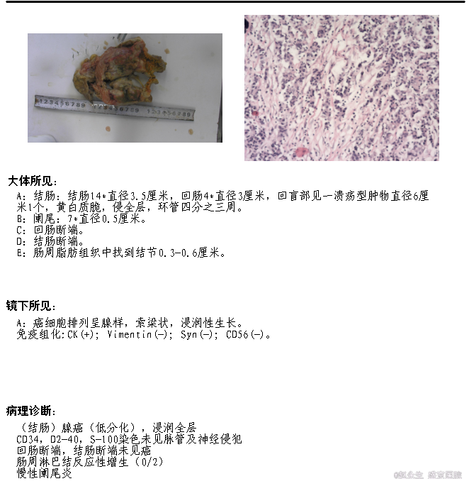 随访 讨论 随访:术后12天患者顺利出院.术后病理回报:低分化腺癌