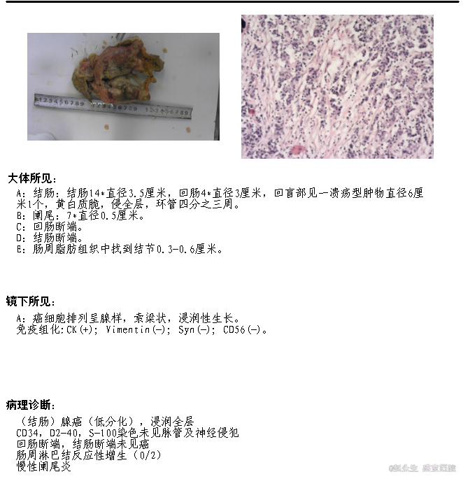 诊断 处理 诊断:盲肠占位性病变 治疗:右半结肠切除