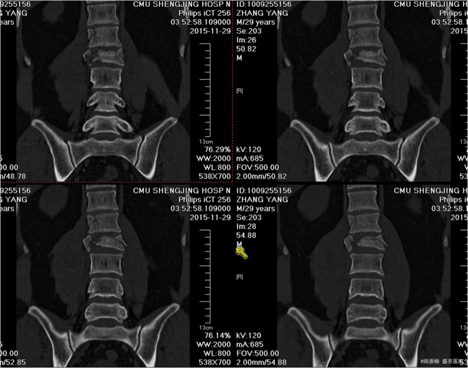 腰椎l2骨折