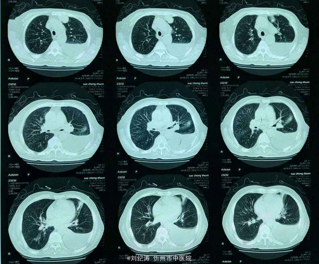 图2—399 慢性淋巴细胞白血病性右胸腔积液-胸部X线影像学图鉴-医学