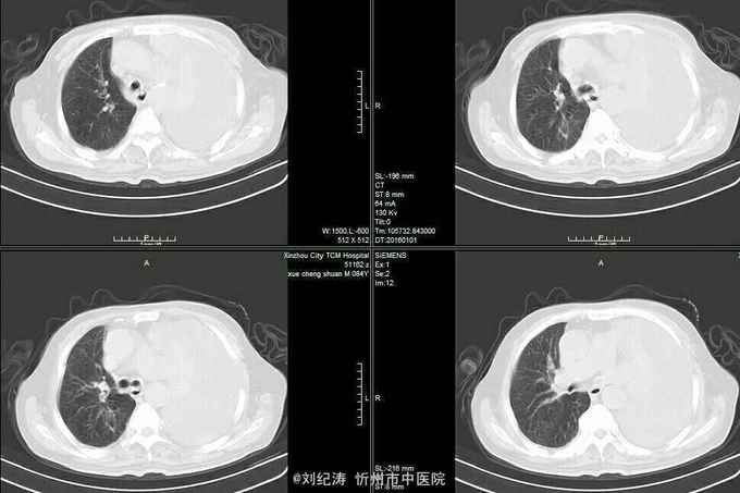 左肺癌并左侧大量胸腔积液,左肺不张