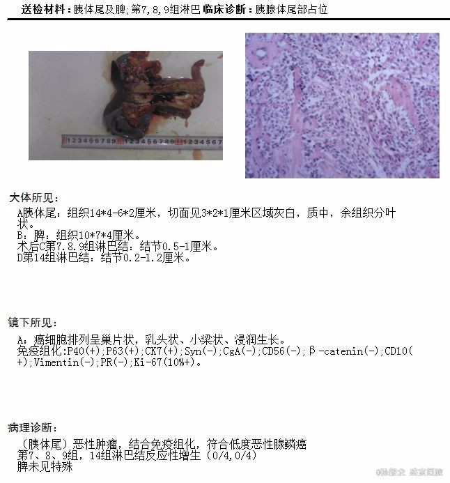 侵及脾动静脉的胰体尾癌手术治疗