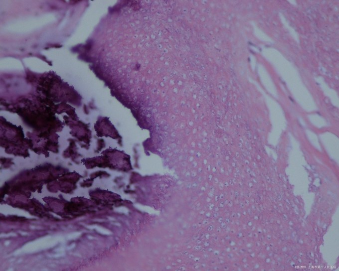 毛母质瘤1瘤