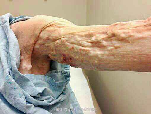主诉 病史  患者女性,50 岁,手臂及腿部进行性弥漫性皮下结节10年.