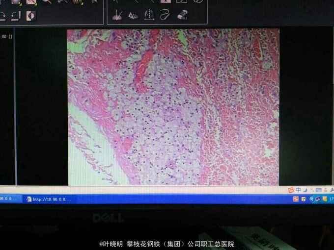 右颌下腺大囊肿一例手术摘除