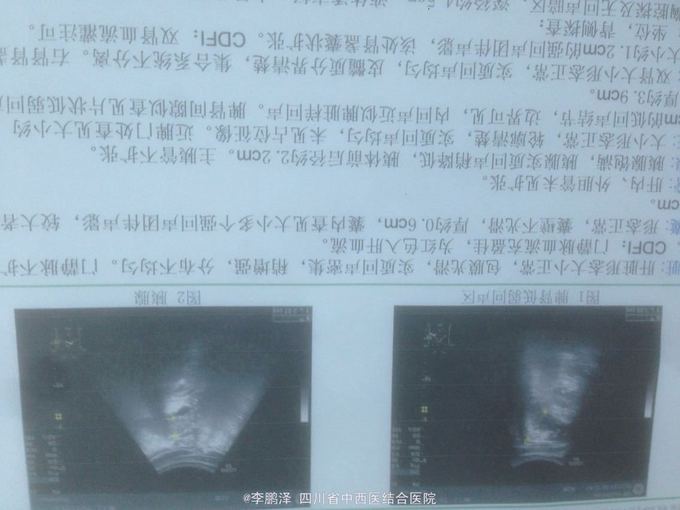 腹部彩超提示:胰腺肿大,胰周积液,肝胆管无明显扩张.