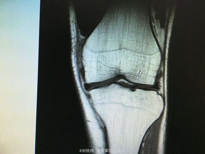 关节镜之膝关节软骨损伤