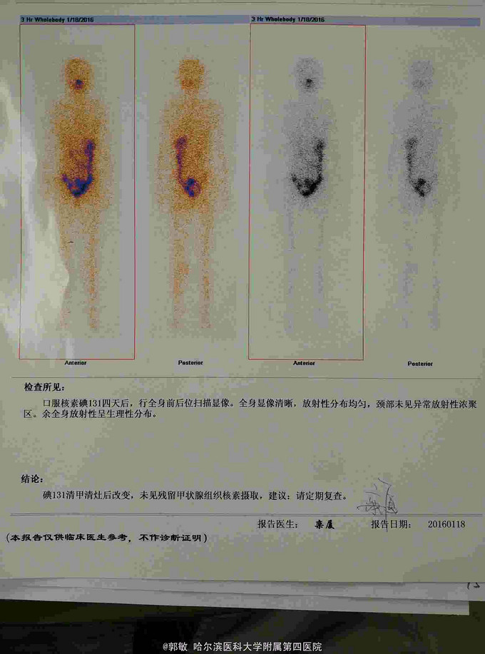 甲状腺癌术后 碘131清甲治疗