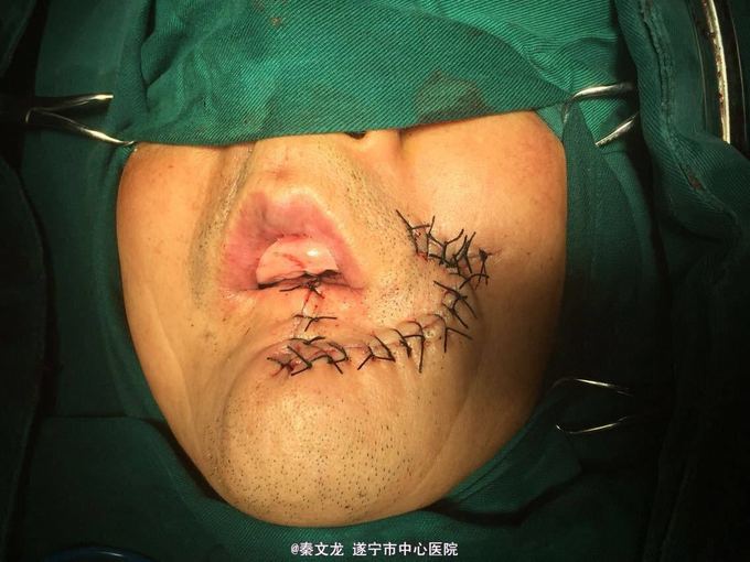 左下唇癌扩大切除后单侧扇形瓣修复一例