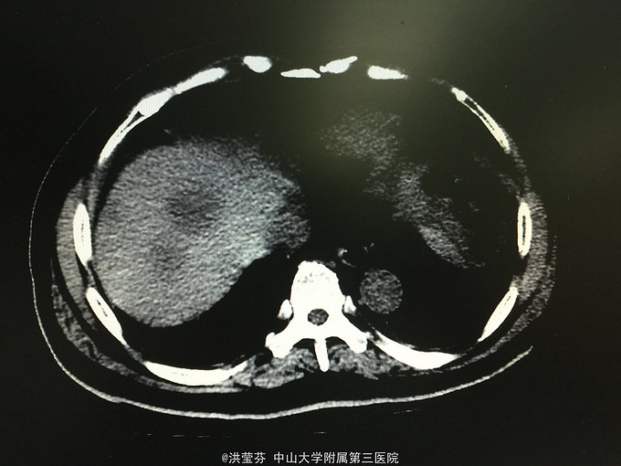 肝胆管细胞癌1例-医联