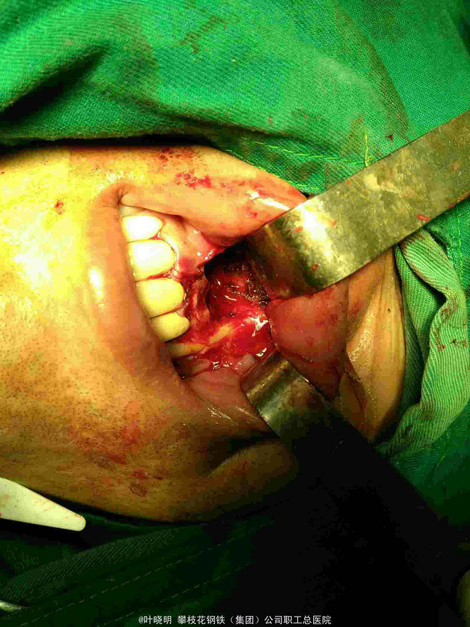左上前牙牙源性颌骨囊肿一例