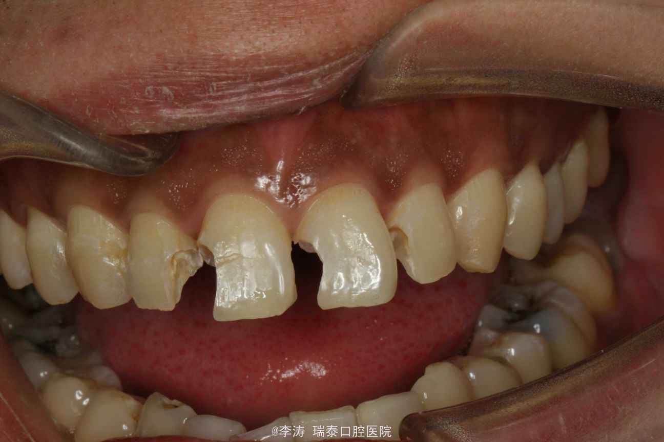 过小牙美学修复——正畸修复联合治疗|丁慧芬&杨涛-成都贝施美生物科技有限公司