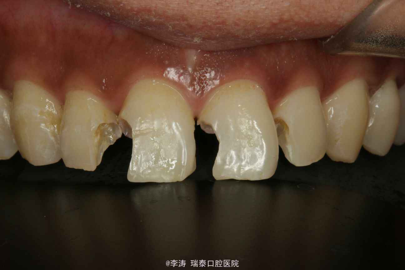 前牙大面积龋坏的树脂修复一例
