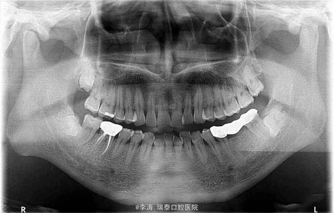 查体 辅查 47牙已开髓,无叩痛.