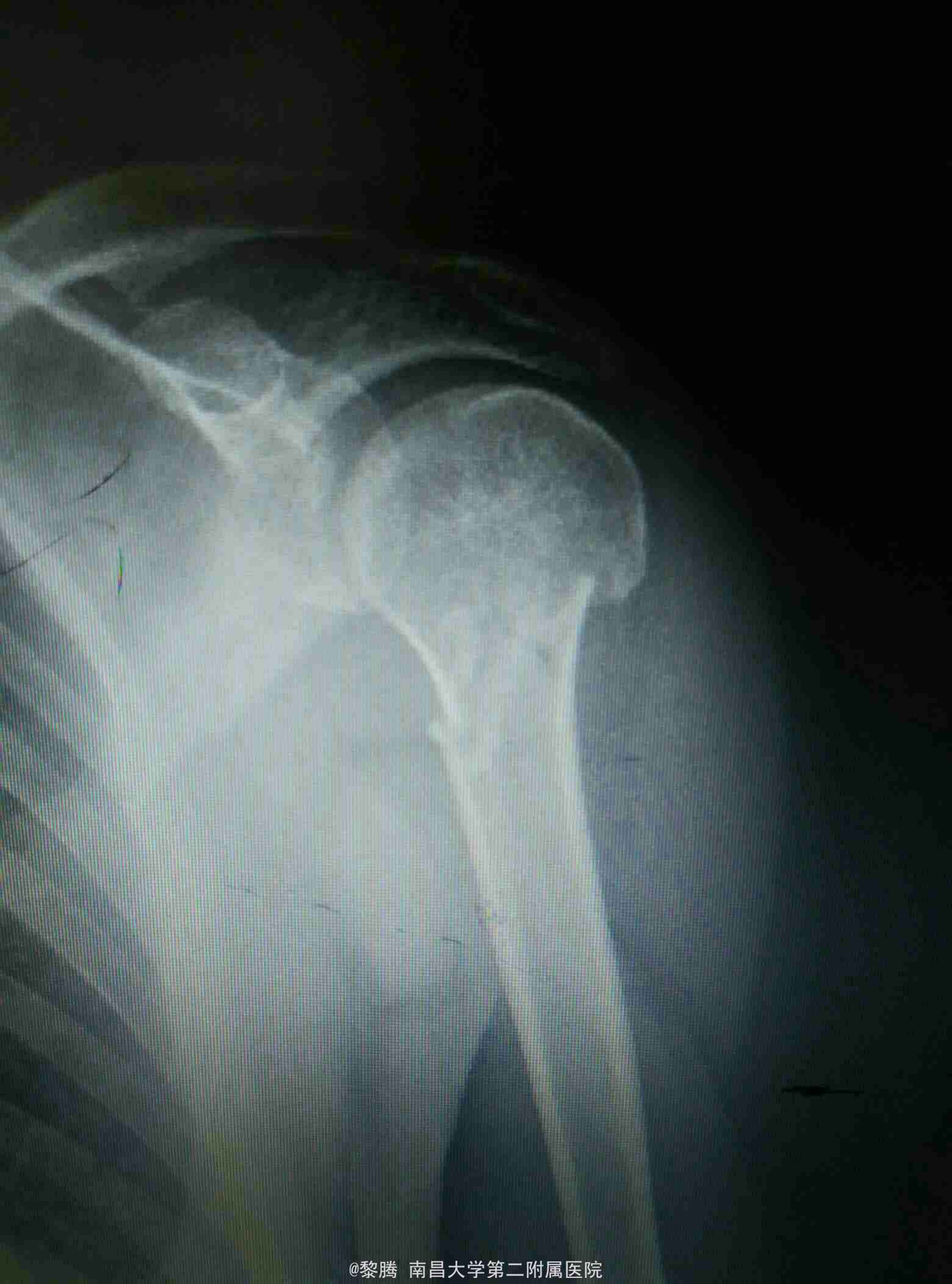 一篇课件读懂髓内钉治疗肱骨近端骨折
