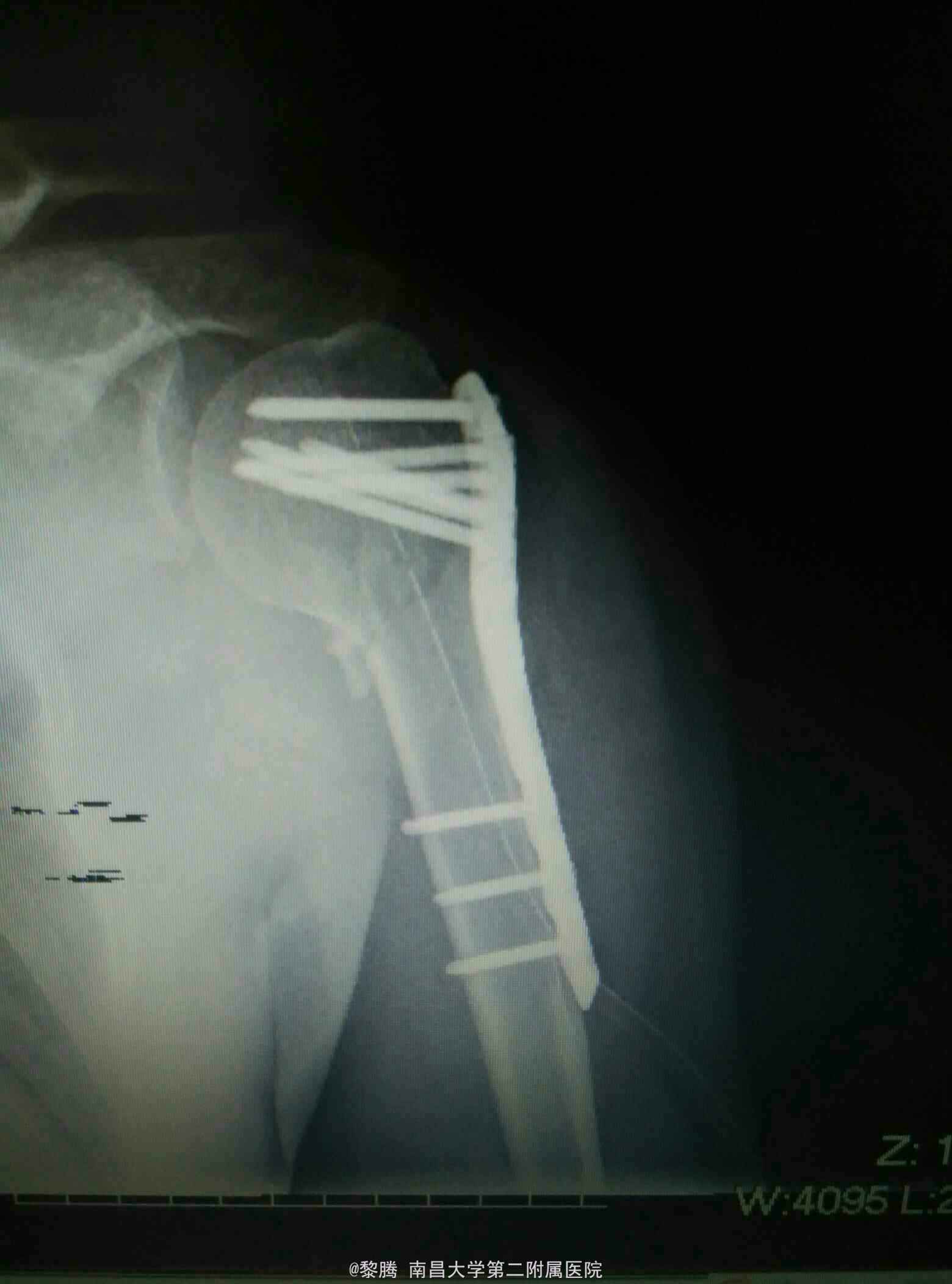 肱骨外科颈粉碎性骨折并肱骨干骨折（切复内固定术）