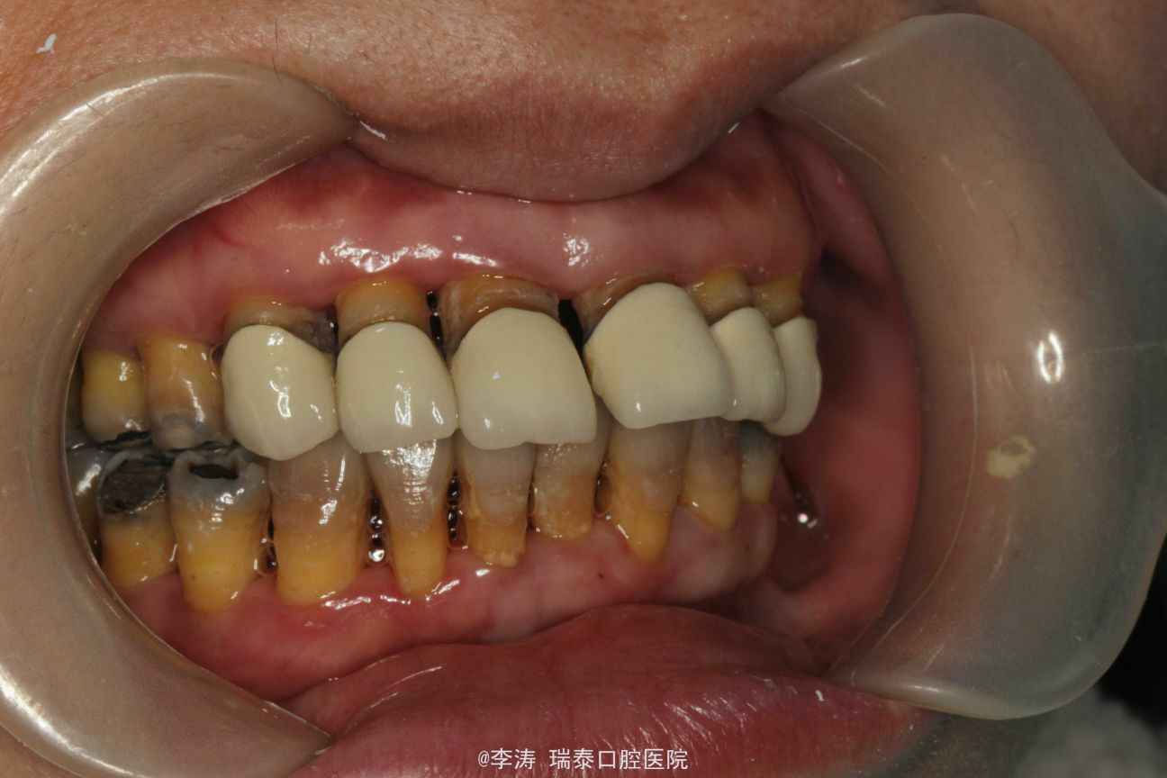正畸案例丨牙列拥挤不齐，牙周病 - 知乎