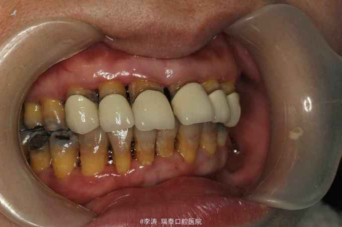 重度牙周炎一例