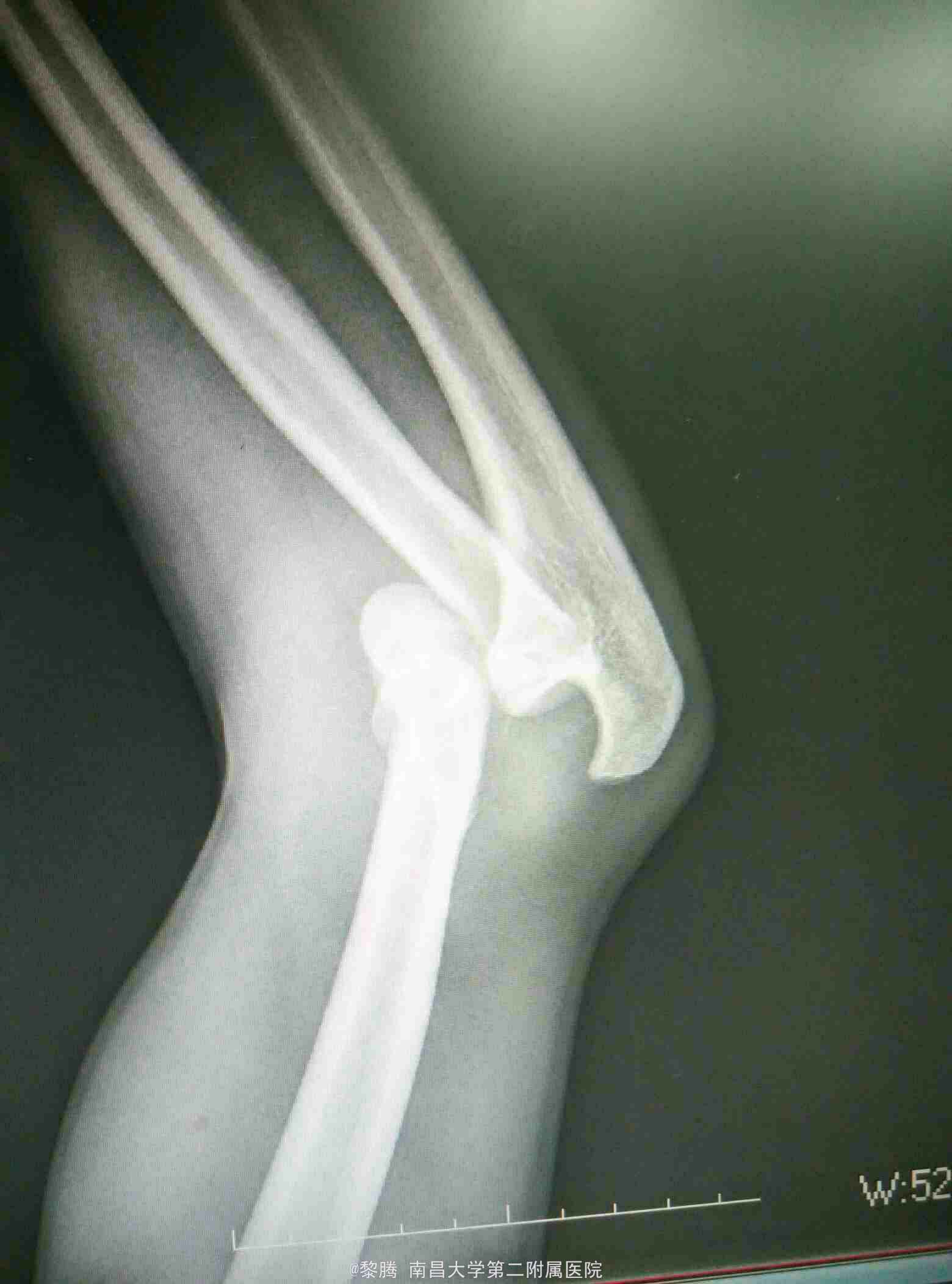 肱骨髁上骨折（GartlandⅢ型）零手术系列之二十六 - 骨科 -丁香园论坛