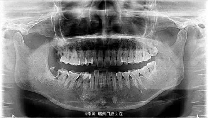 下后牙c型根管一例