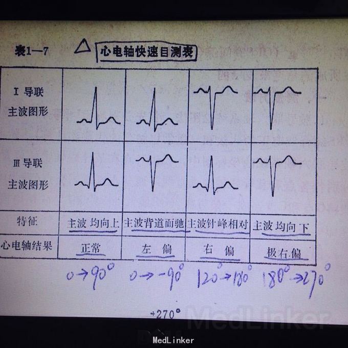 有的写看一三导联,有的是看一导联和avf导联.