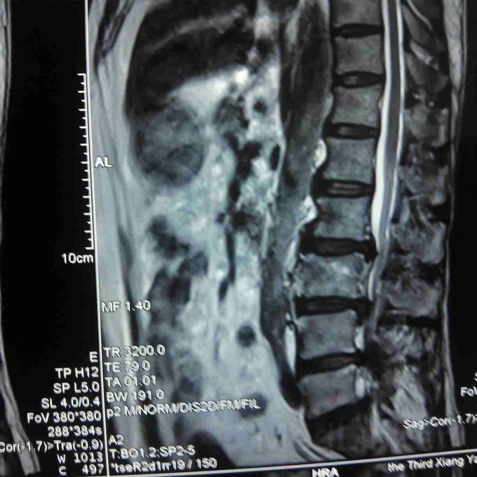 腰椎后纵韧带骨化多见么如何选择手术方式