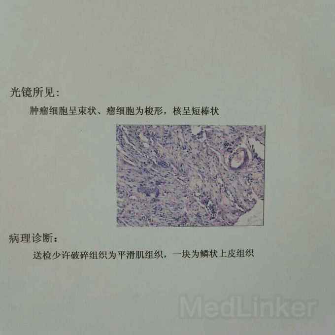 患者,女,48岁,彩超检查子宫肌瘤,ct检查占位,核磁检查怀疑肉瘤,穿刺