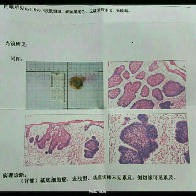 奶奶忘拔电三轮钥匙5岁孙女误发动撞进人群